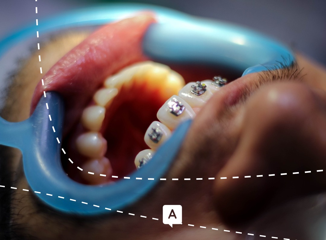 découvrez comment les remboursements d'orthodontie pour adultes sont pris en charge par votre mutuelle. explorez les différentes options et garanties pour optimiser vos soins orthodontiques et profiter d'un sourire éclatant à tout âge.